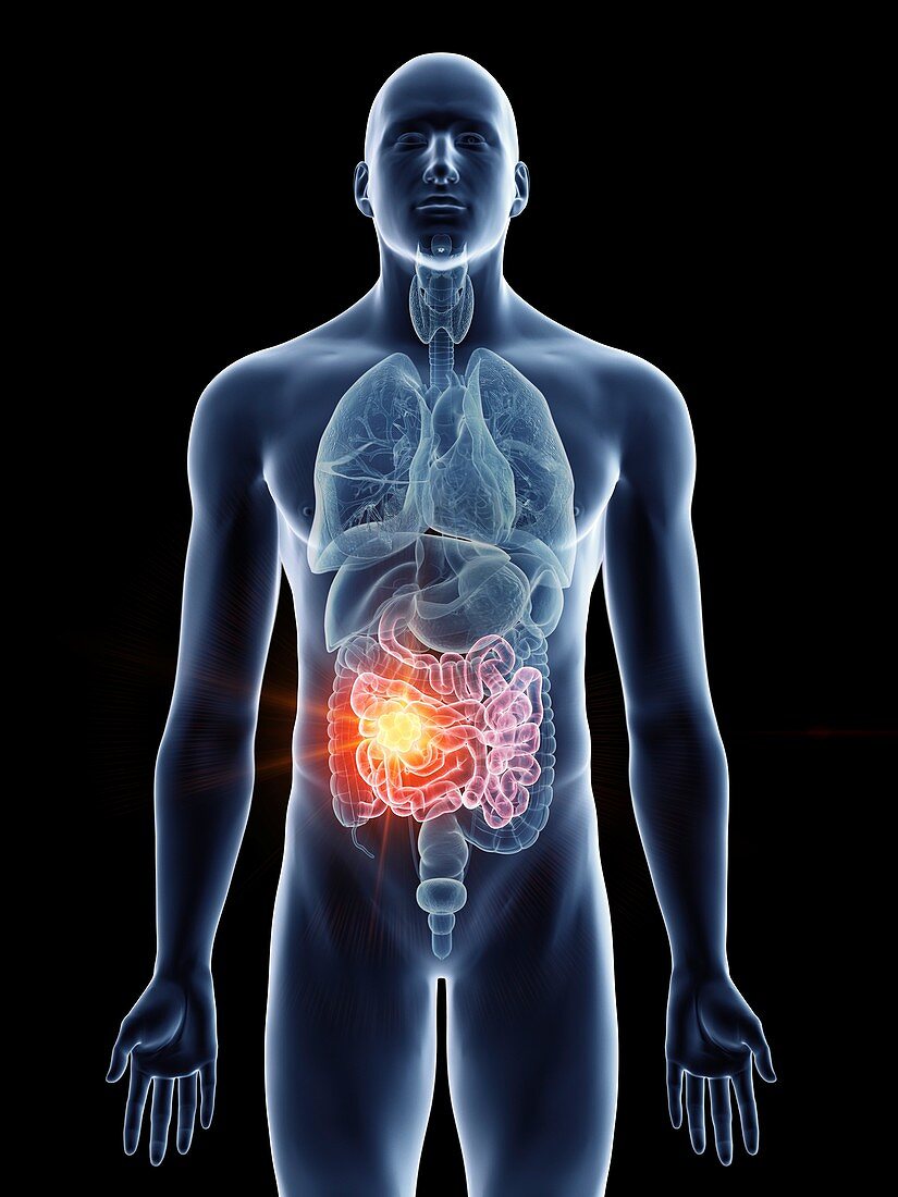 Illustration of a man's small intestine cancer