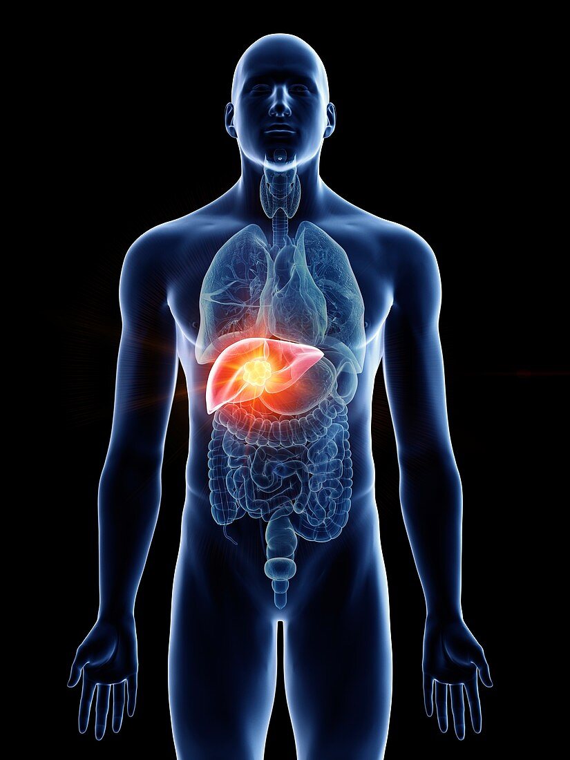 Illustration of a man's liver cancer