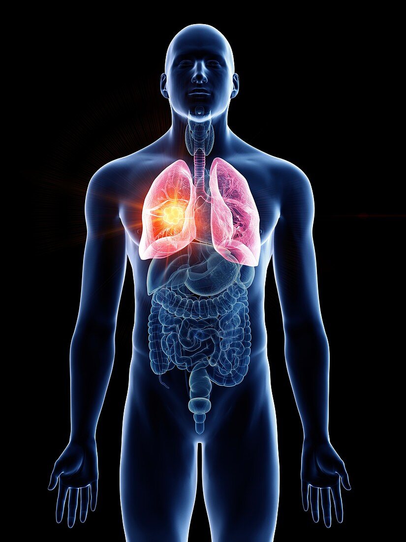 Illustration of a man's lung cancer