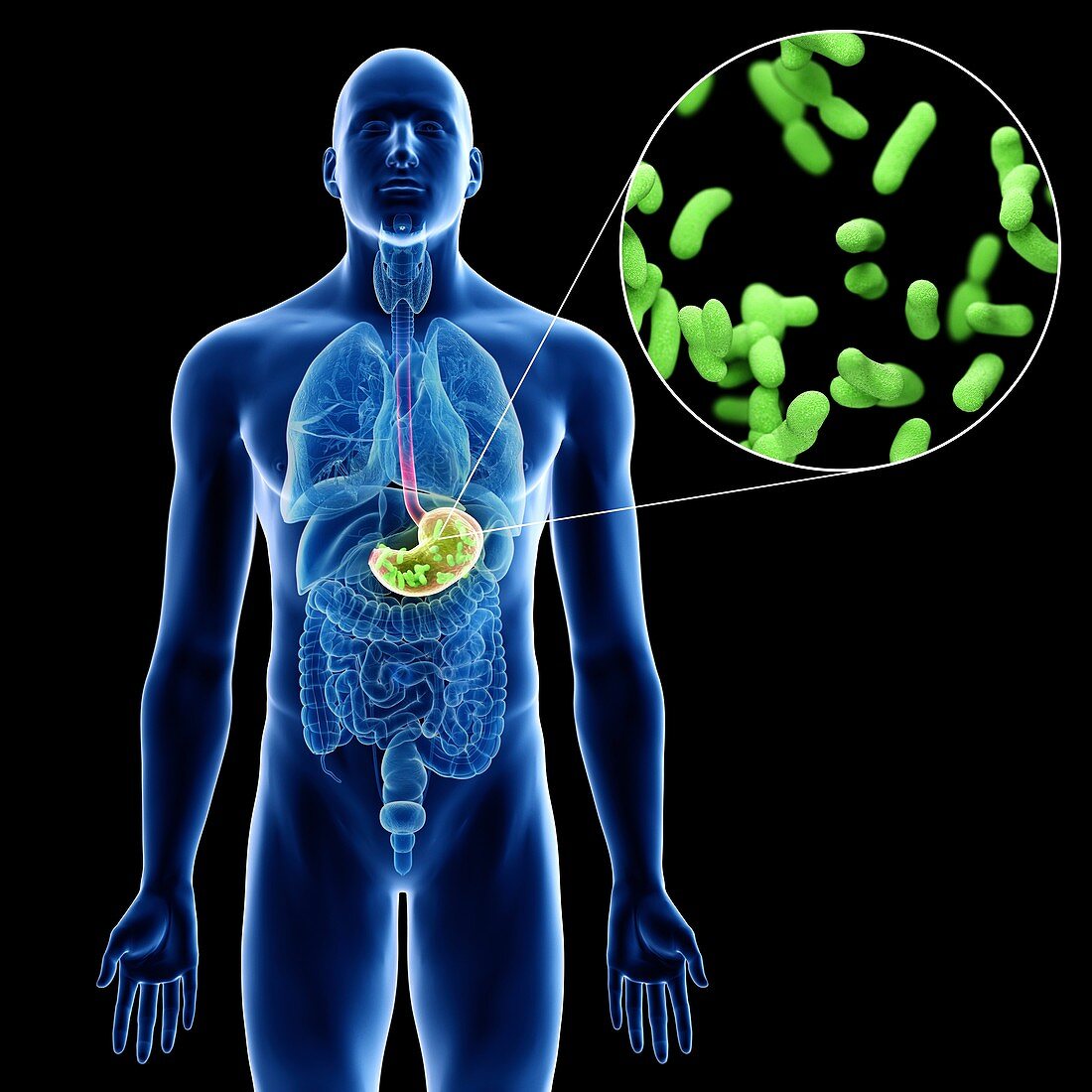 Illustration of a man's stomach infection