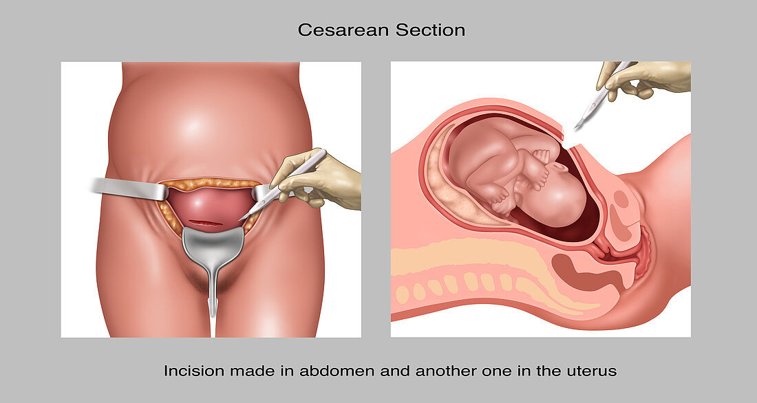 Caesarean Section Incisions, Illustration