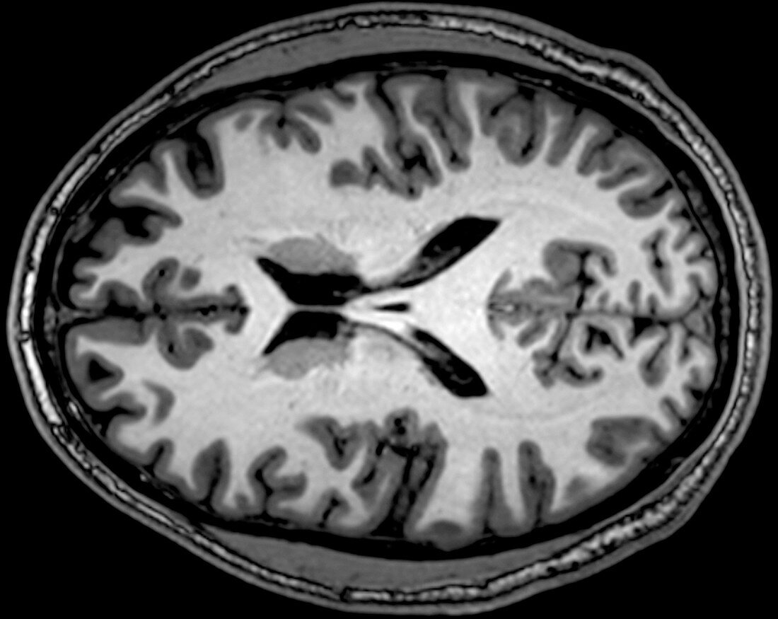 Normal Brain, MRI, Dorsal View