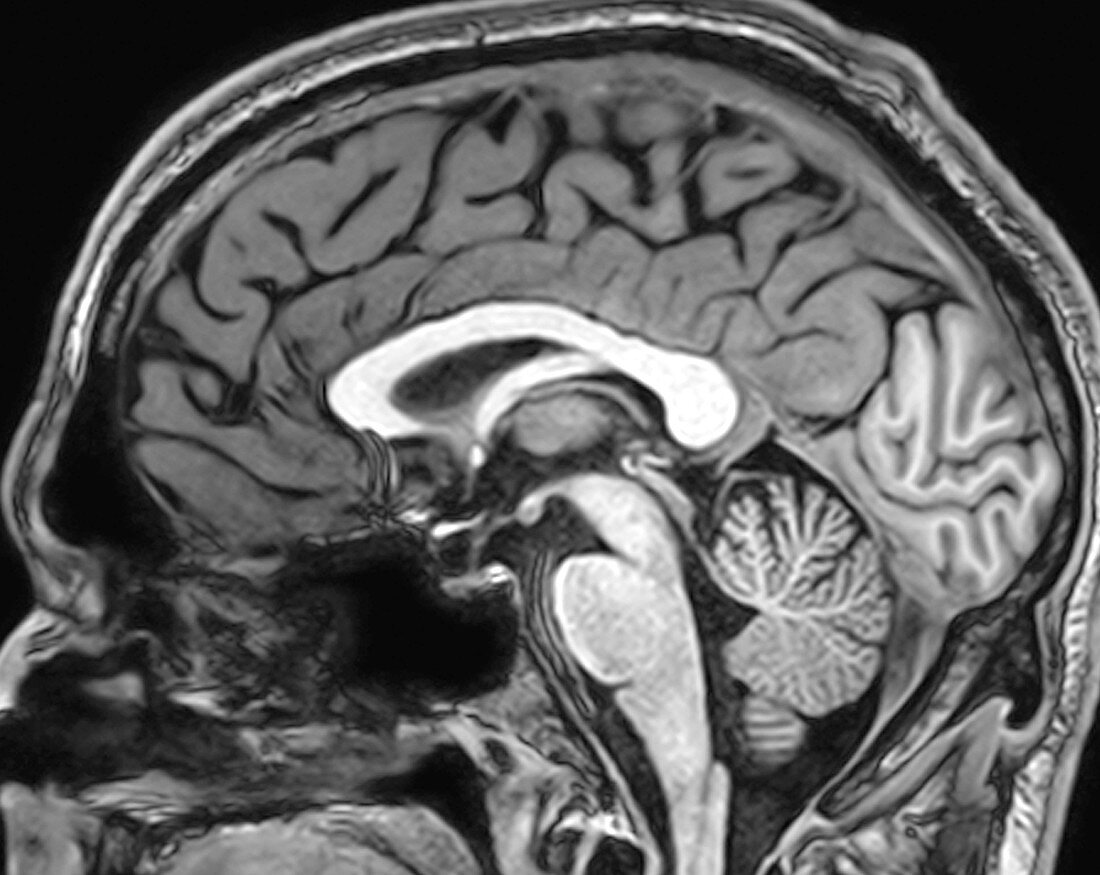 Normal Brain, MRI, Medial View
