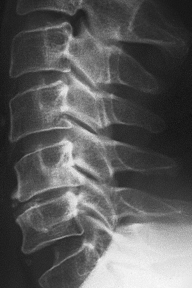 Osteoarthritis in Vertebrae C5-C6, X-ray