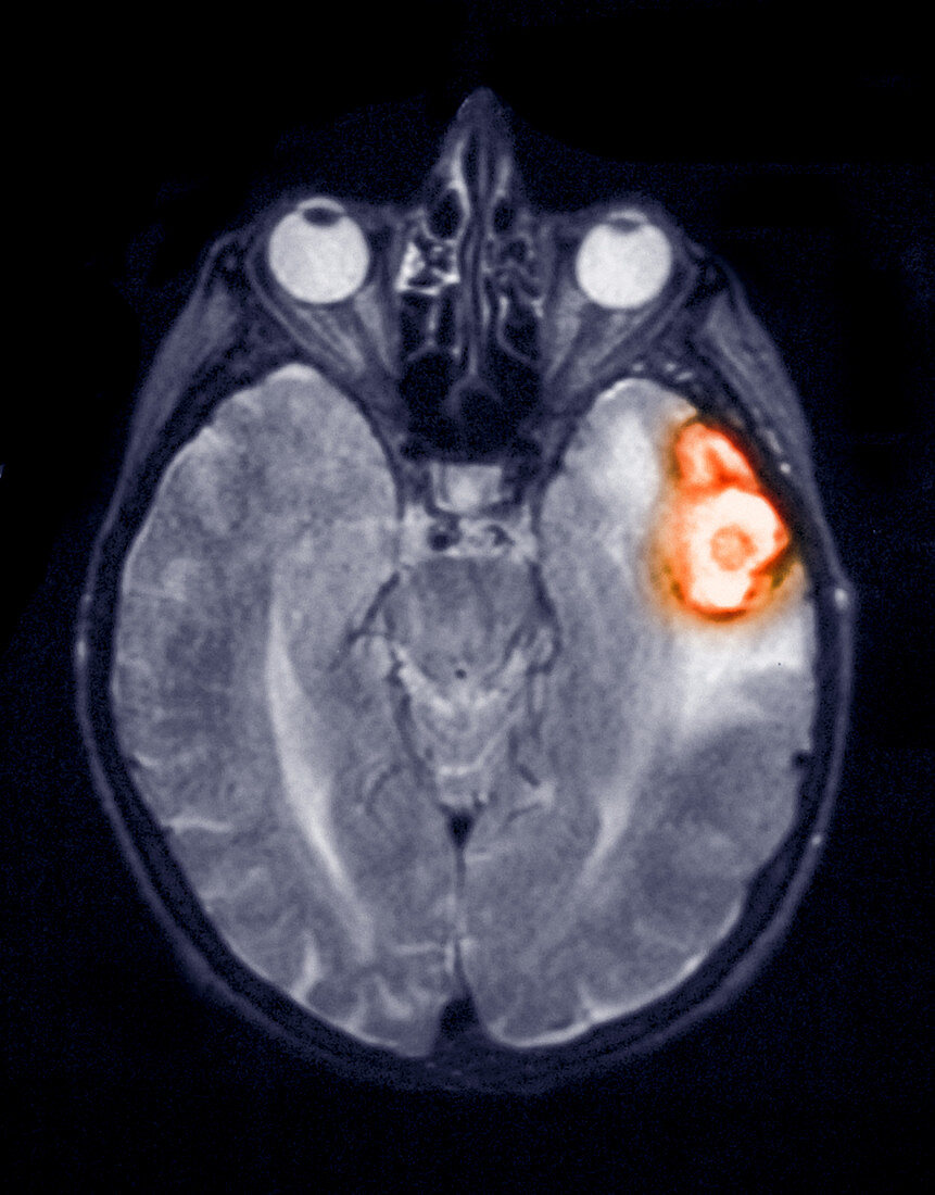 Temporoparietal brain haemorrhage, MRI