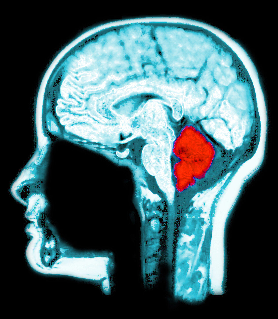 Location of Cerebellum, MRI