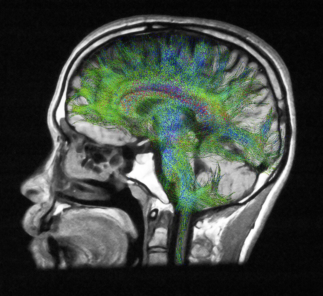 Normal Brain, Fibre Tractography and MRI