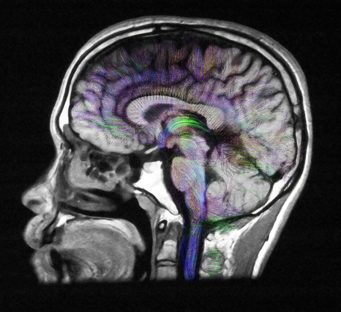 Normal Brain, Fibre Tractography and MRI