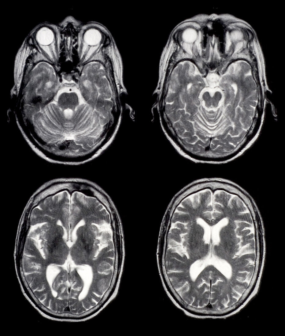 Normal Brain of 65 Year Old Woman, MRI
