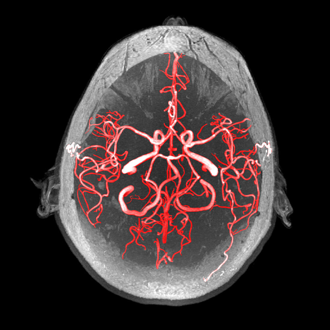 Arteries of the Brain, MRA