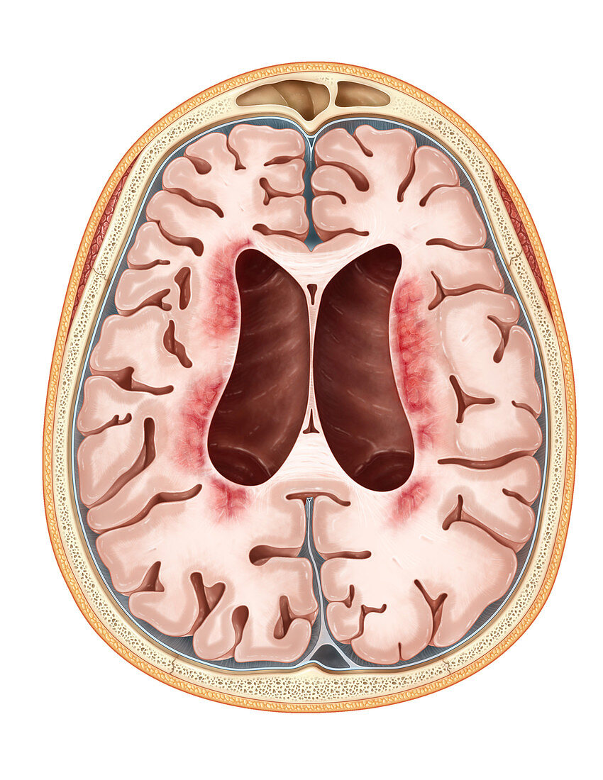 Neuronal Ceroid-Lipofuscinosis
