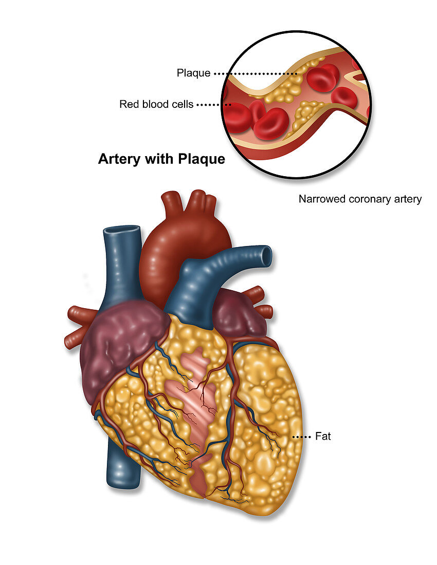 Heart Artery with Plaque, Illustration