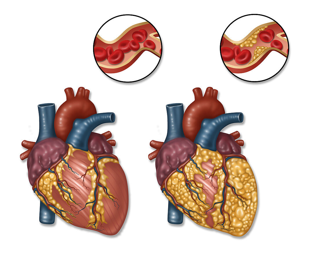 Heart and Artery, Normal vs. Hardened