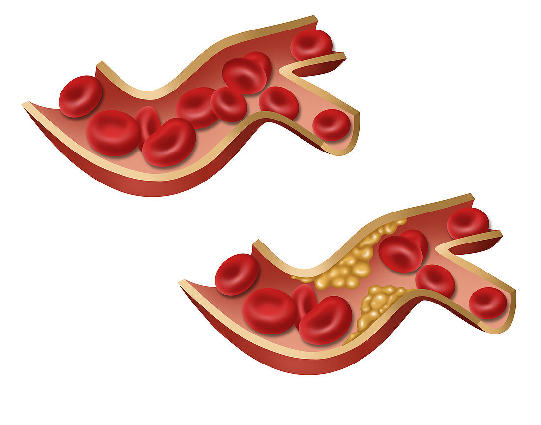 Artery, Normal vs. Hardened, Illustration