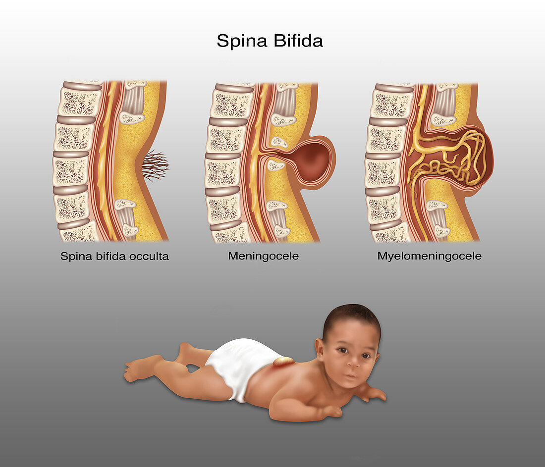 Spina Bifida, Illustration