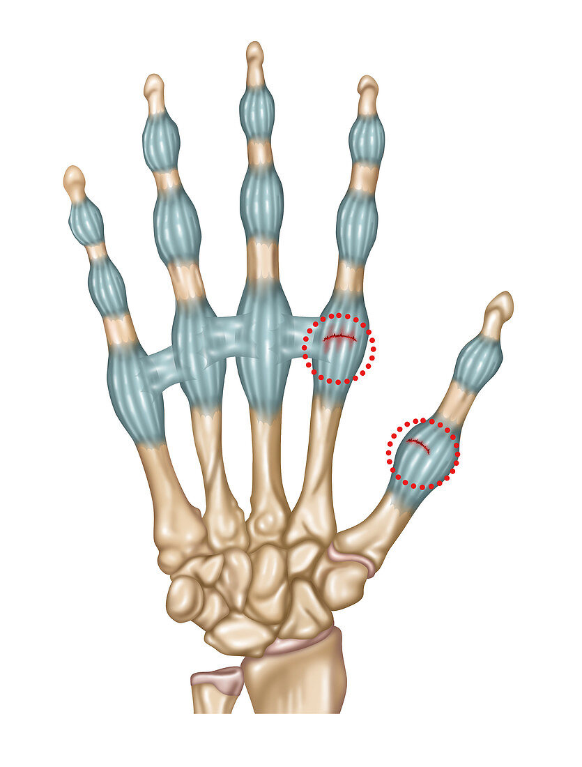 Sprained Finger & Thumb, Illustration