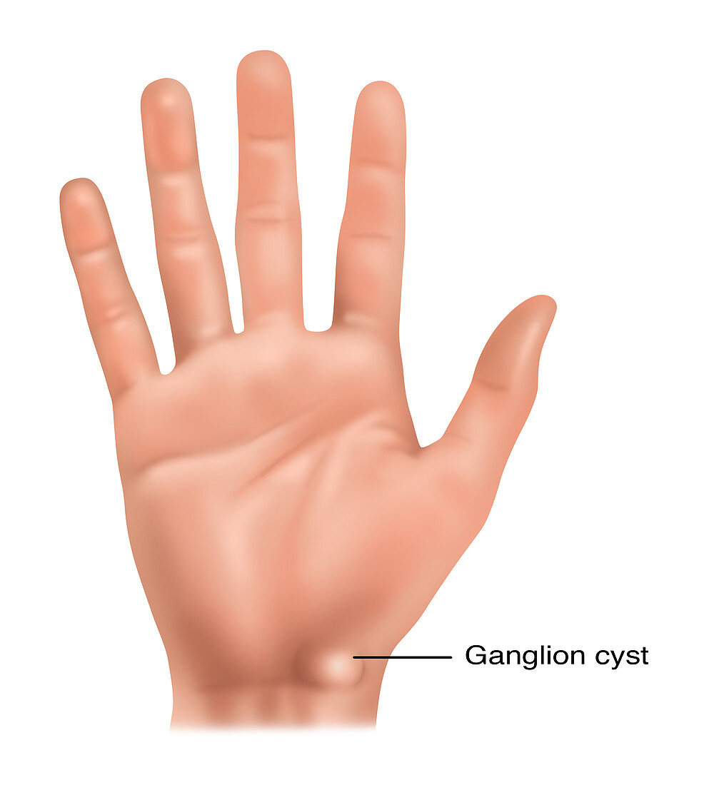 Ganglion Cyst, Illustration