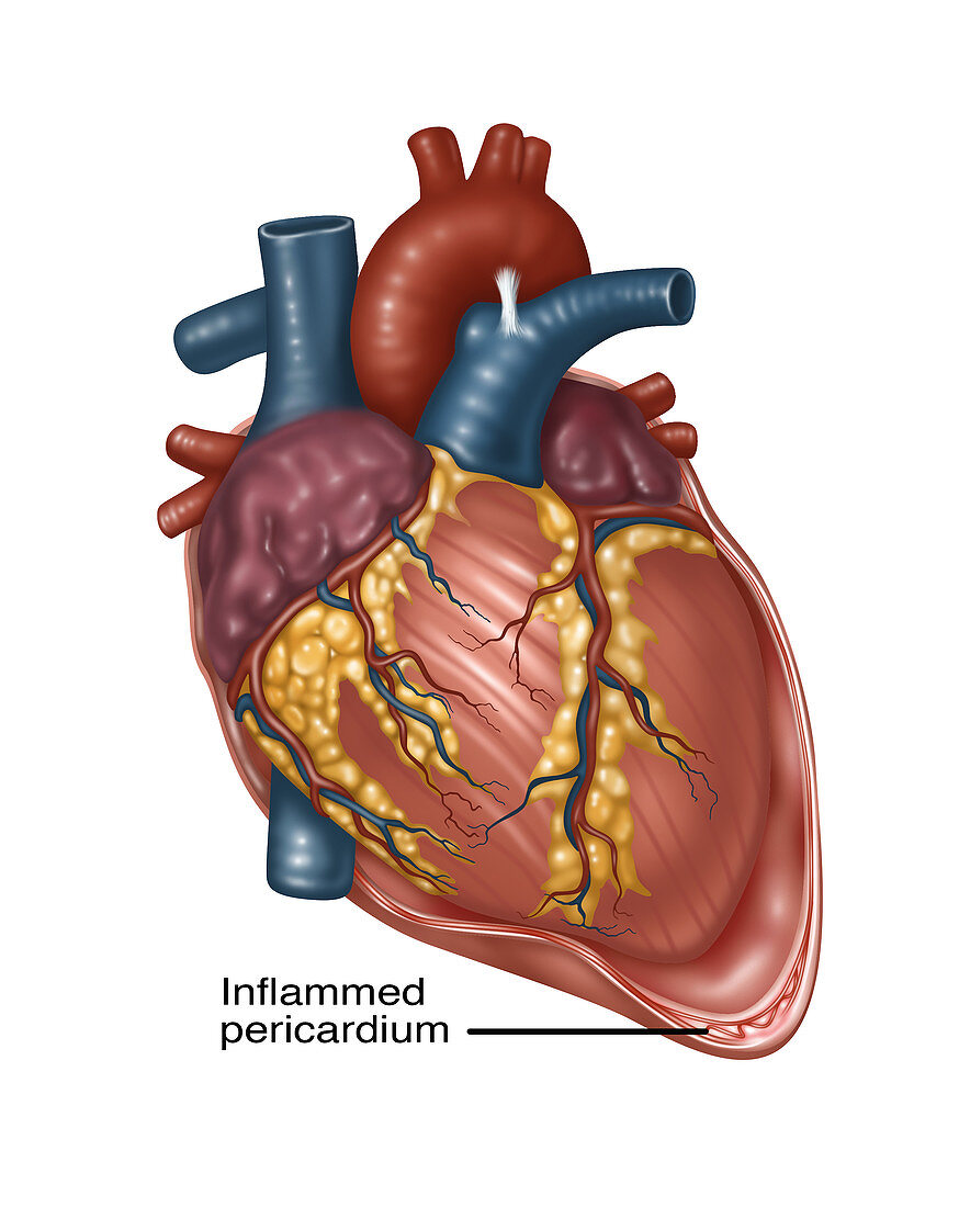 Heart with Pericarditis, Illustration