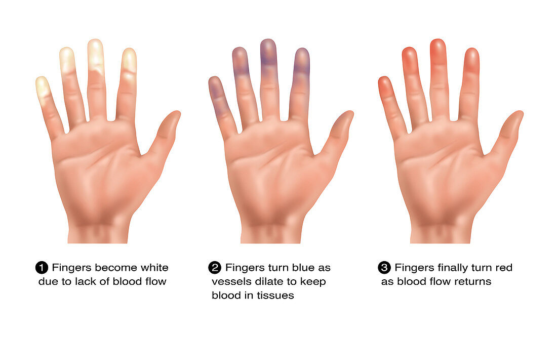 Raynaud's Disease Information Pamphlet