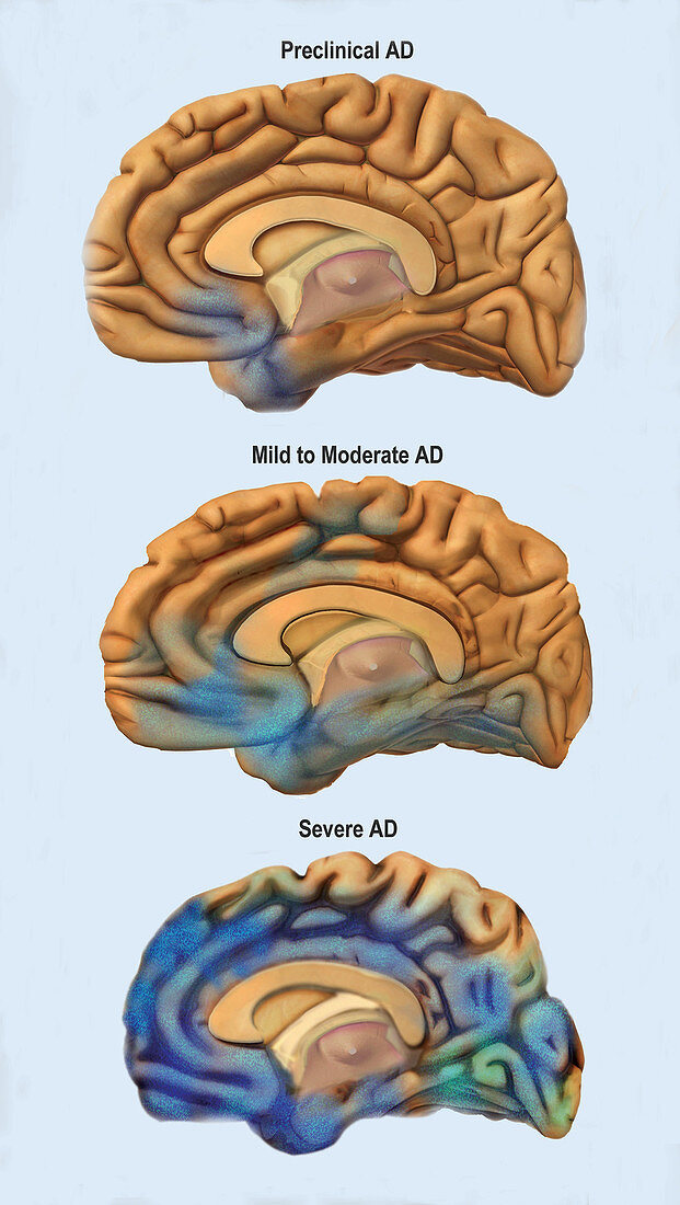 Alzheimer's Disease, Severity Comparison