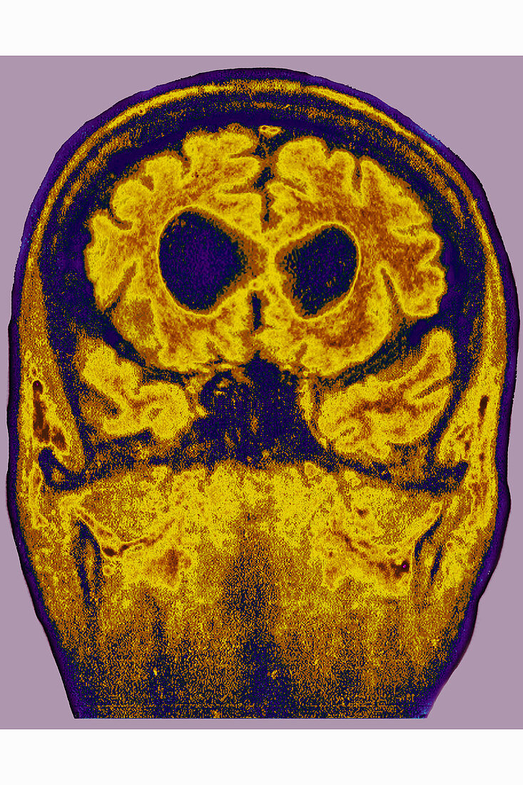 Alzheimer's disease, MRI