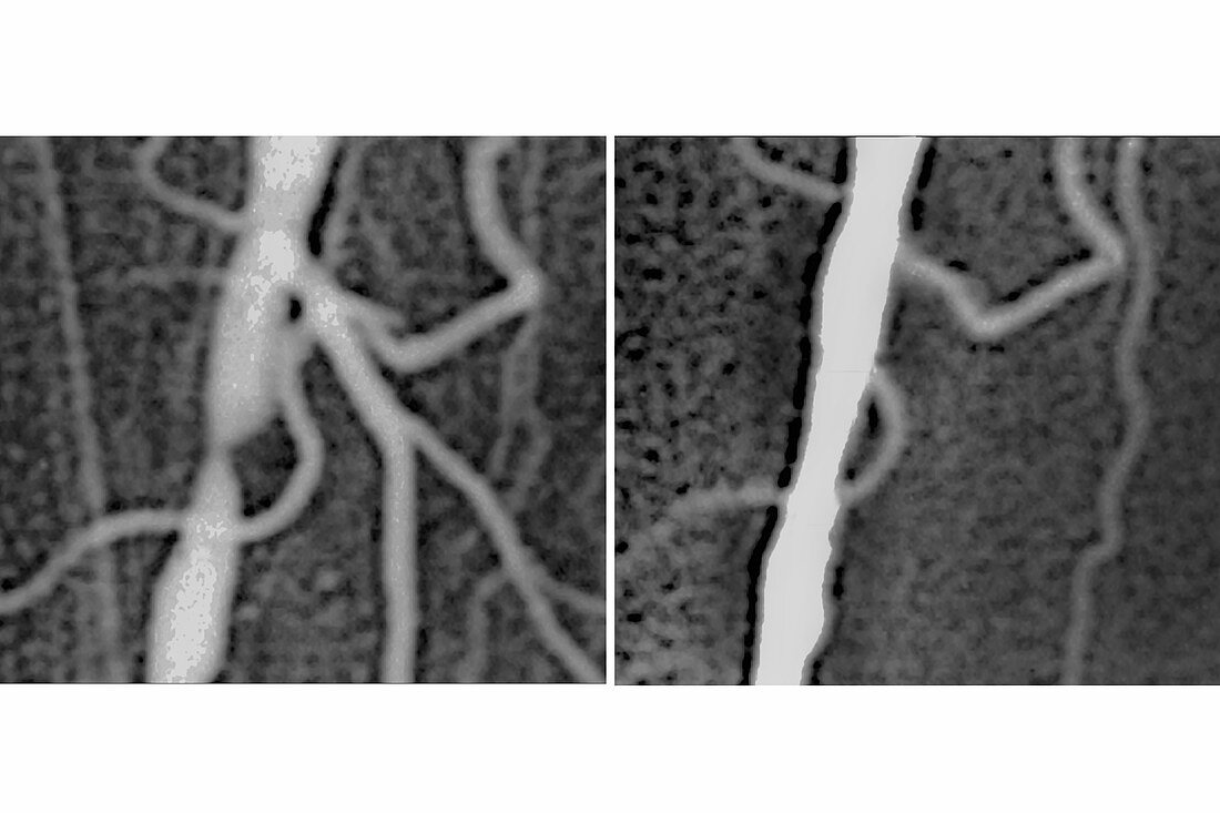 Angioplasty, before and after