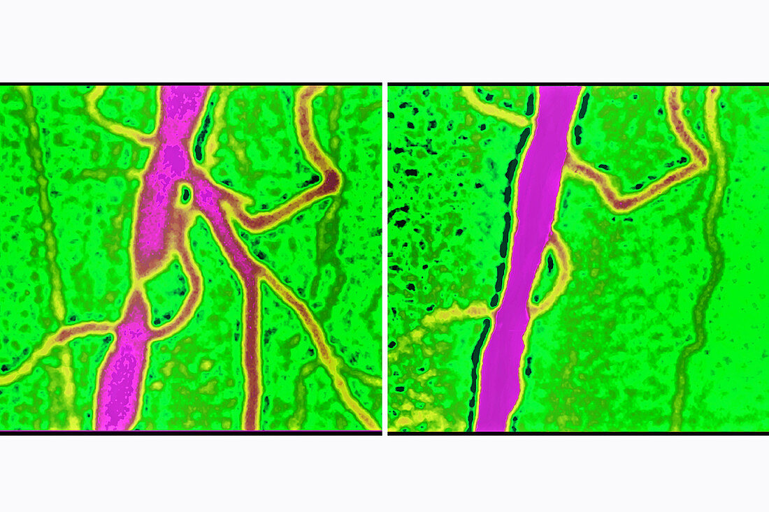 Angioplasty, before and after