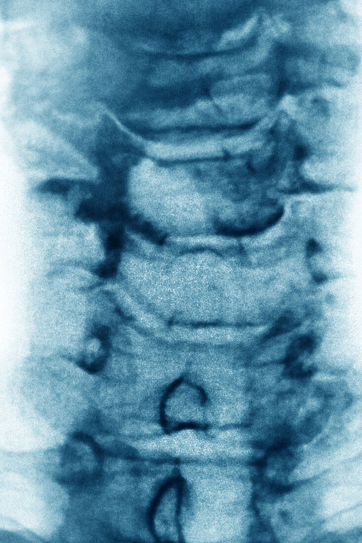 Cervical spondylosis, X-ray