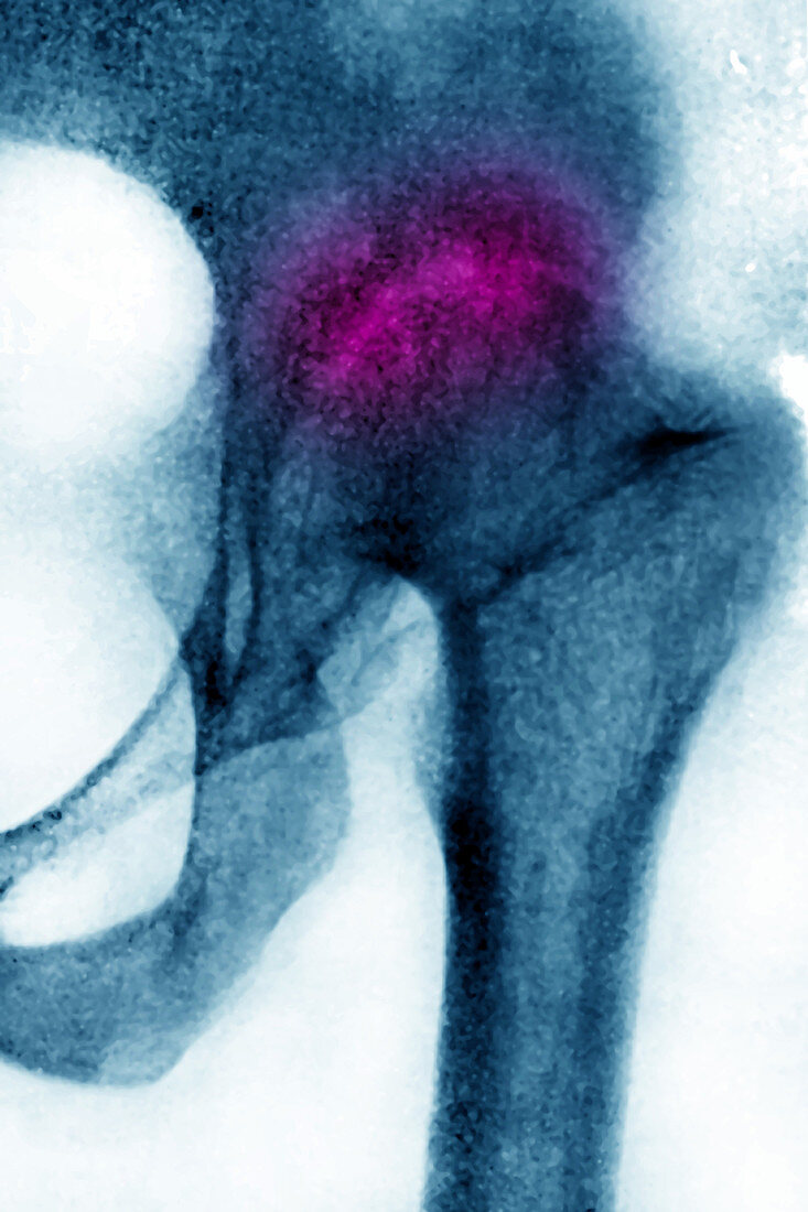 Osteoarthritis, X-ray