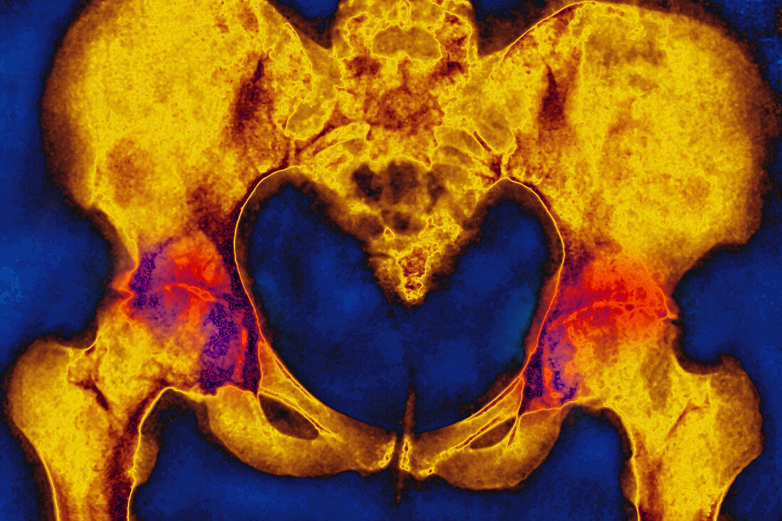 Arthritis of the hips, X-ray