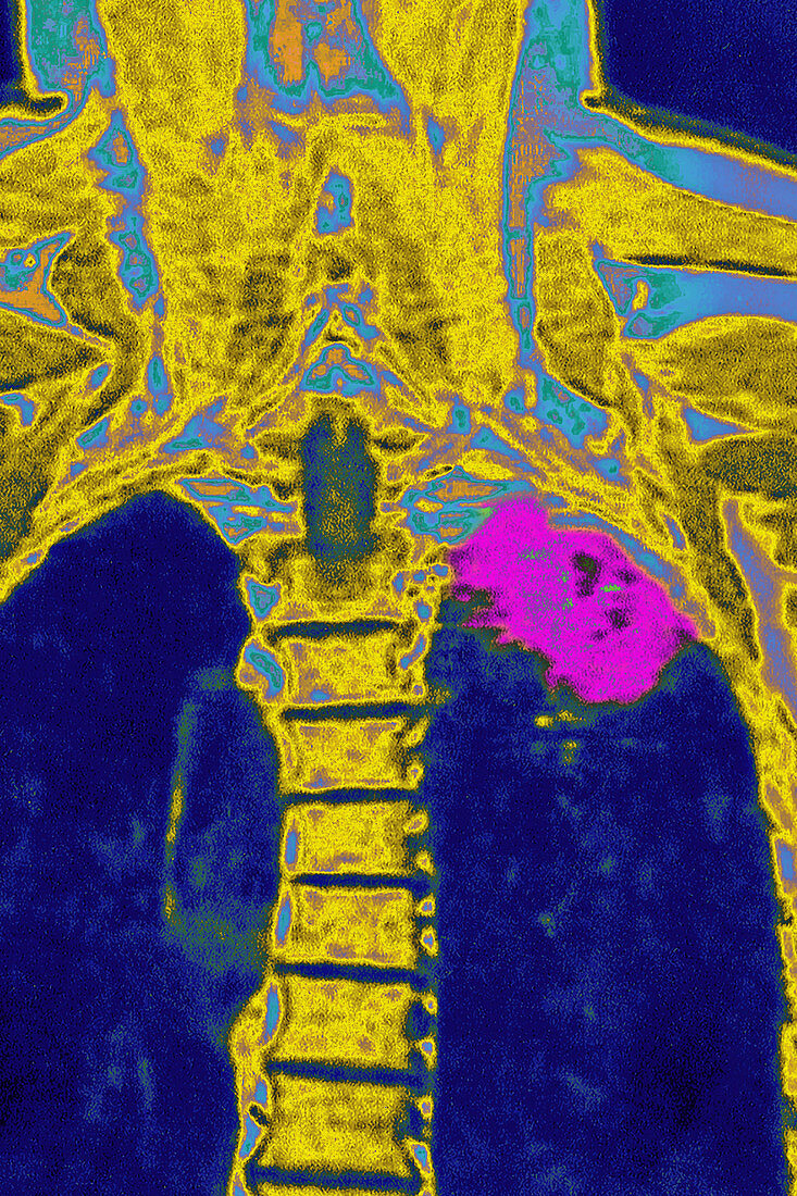 Lung cancer, X-ray