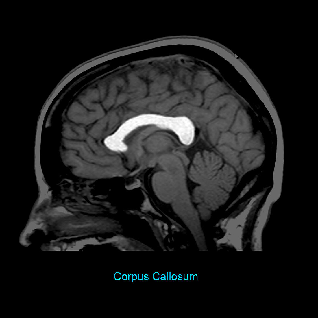 Corpus Callosum, Sagittal MRI