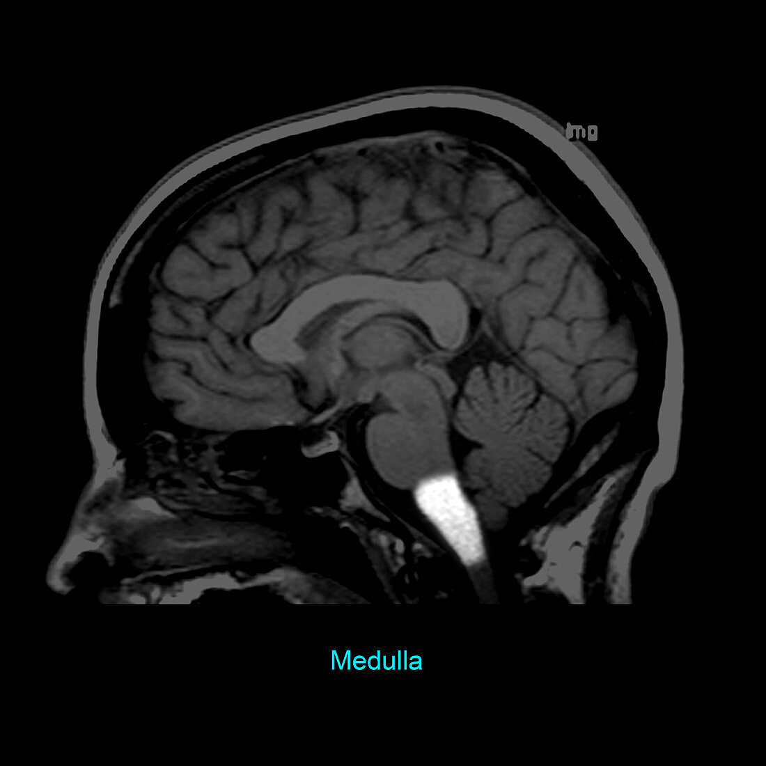 Medulla, Sagittal MRI