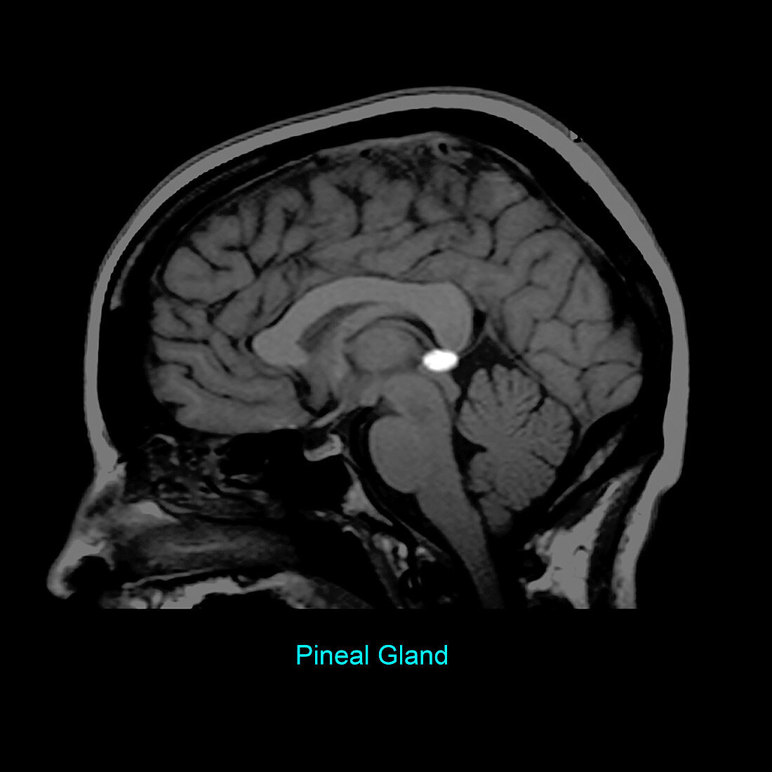 Pineal Gland, Sagittal MRI
