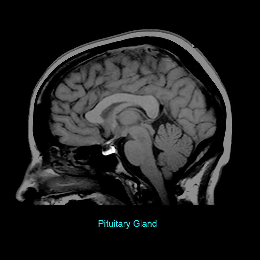 Pituitary Gland, Sagittal MRI