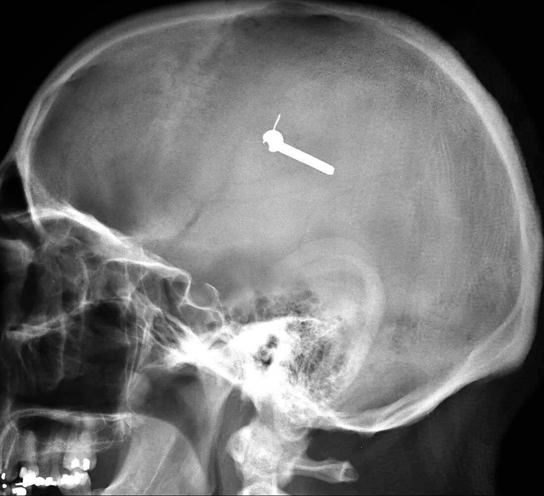 Nail in Brain, X-ray