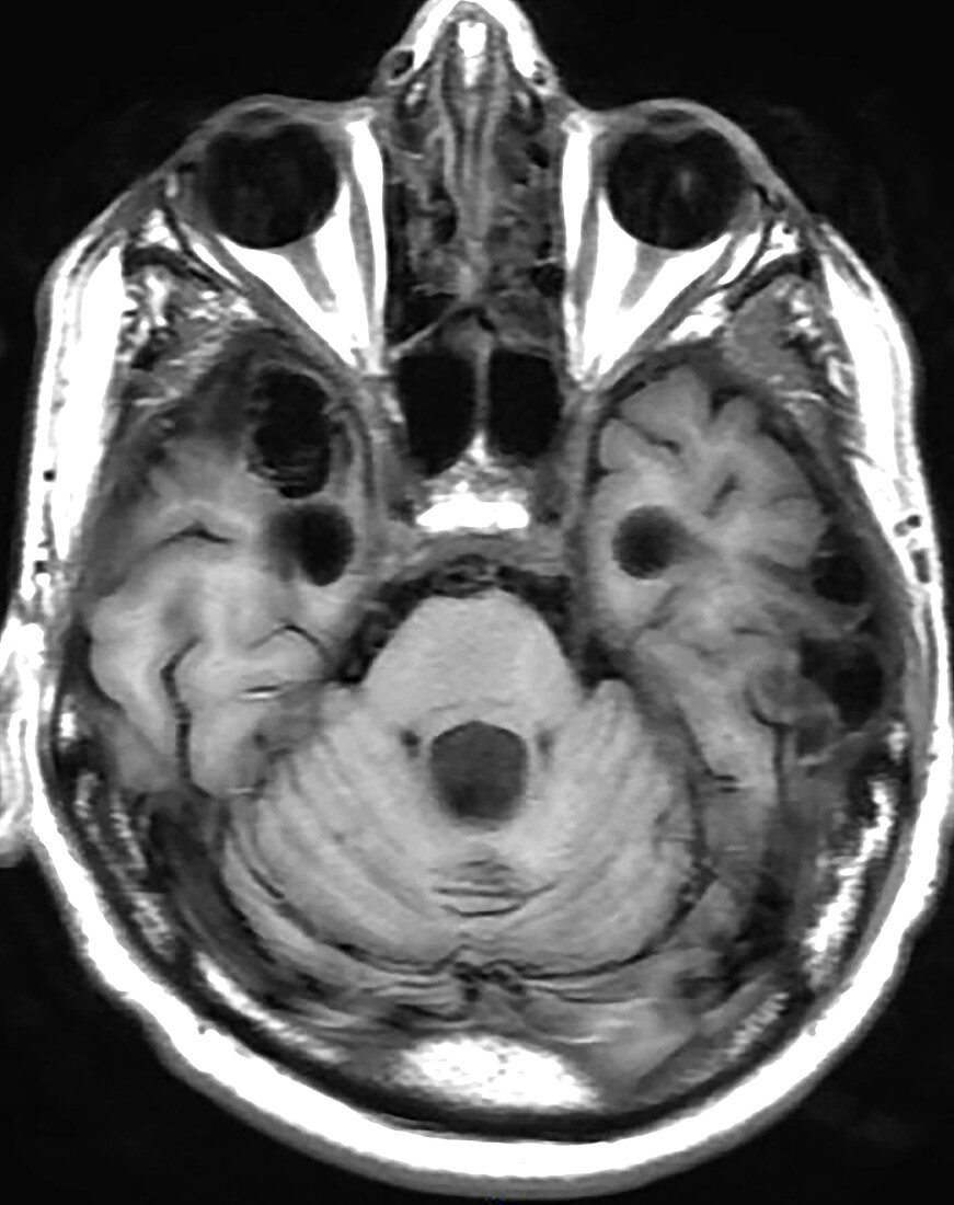 Chronic Post-Traumatic Brain Injury, MRI