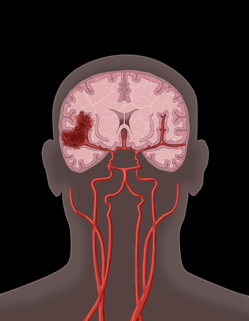 Haemorrhagic Stroke, Illustration