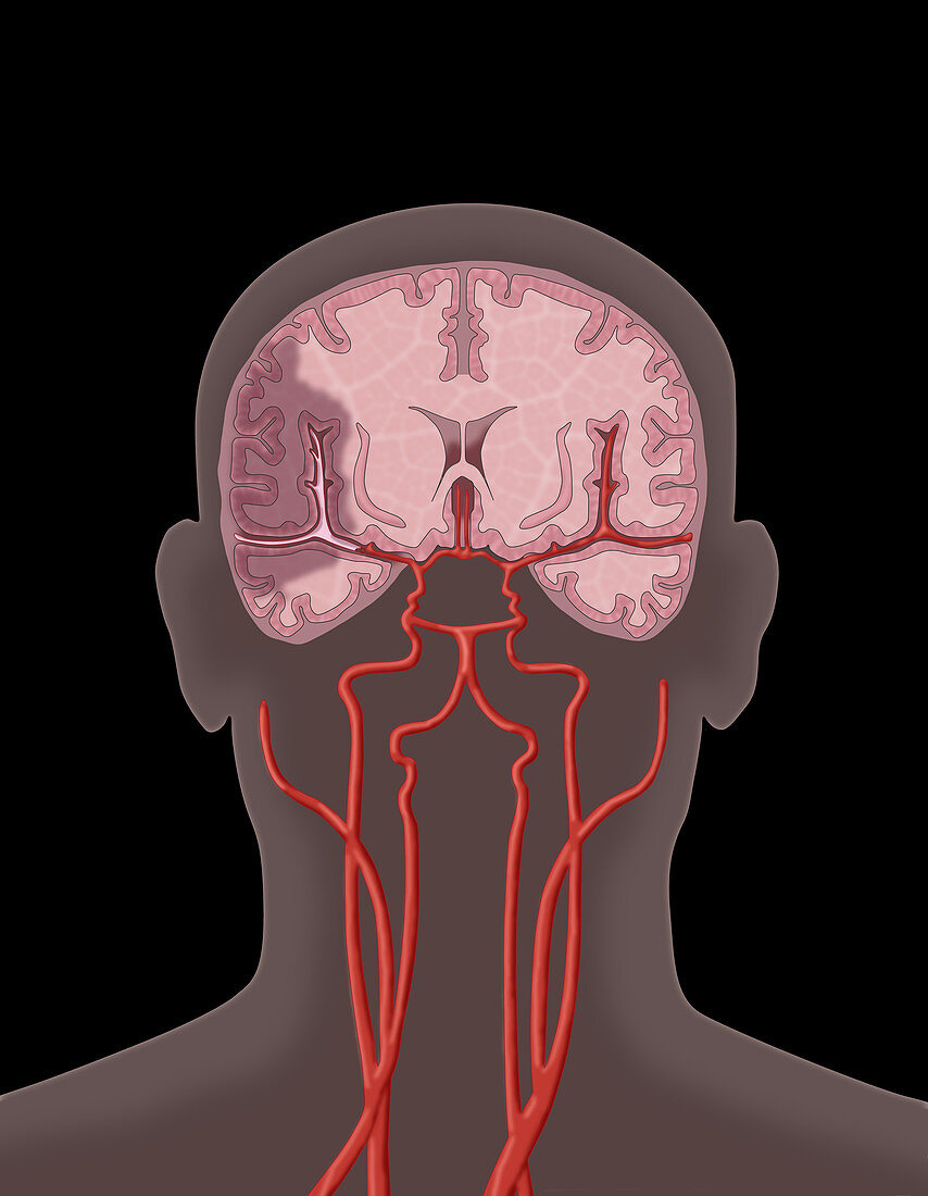 Ischemic Stroke, Illustration