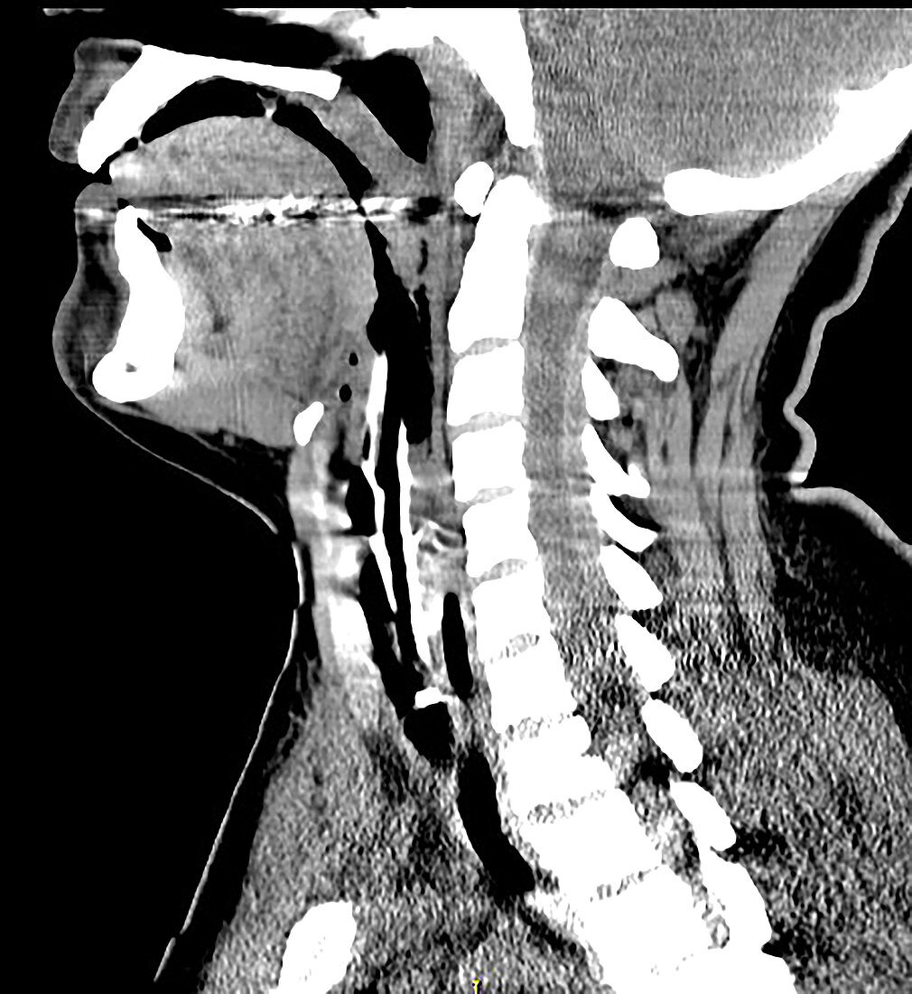 CT Spinal Epidural Hematoma