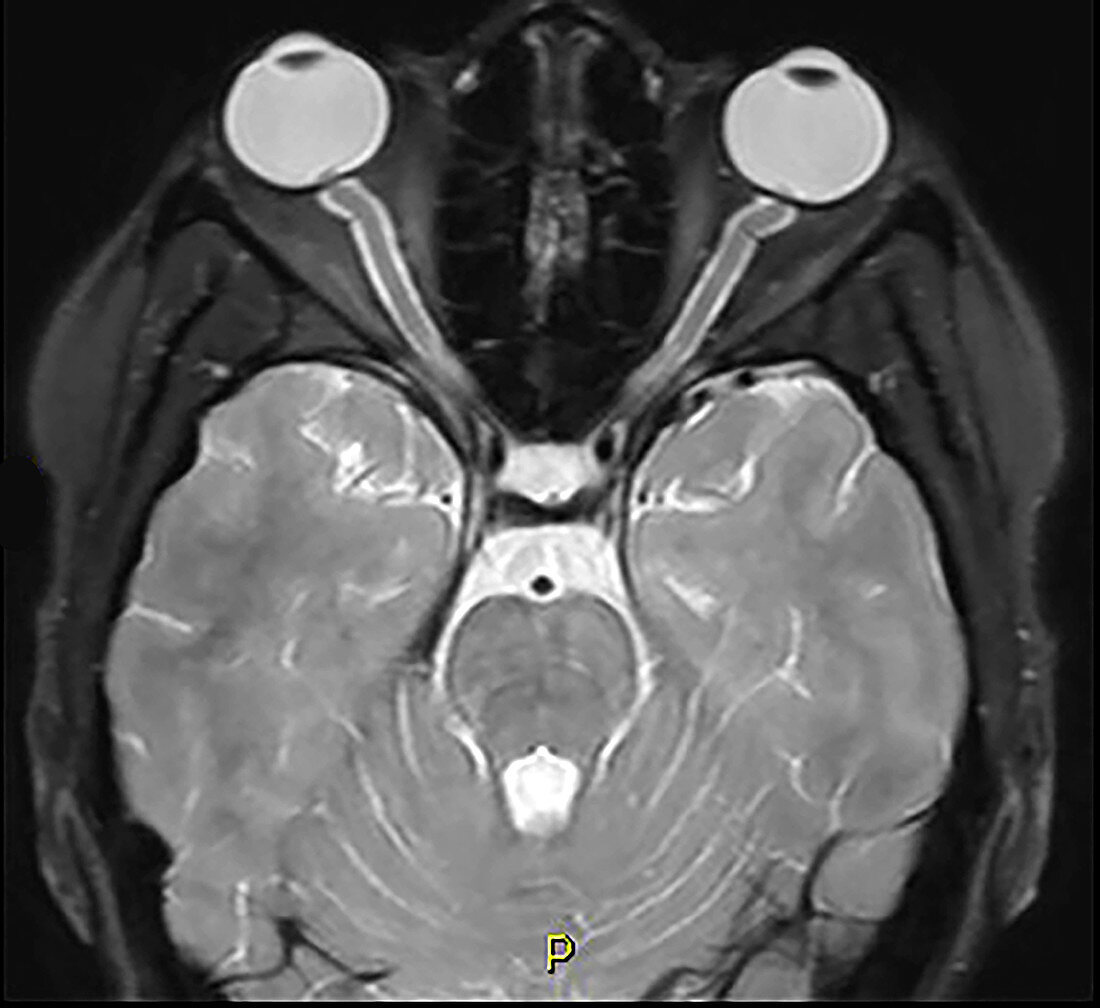 Increased Intracranial Pressure, MRI
