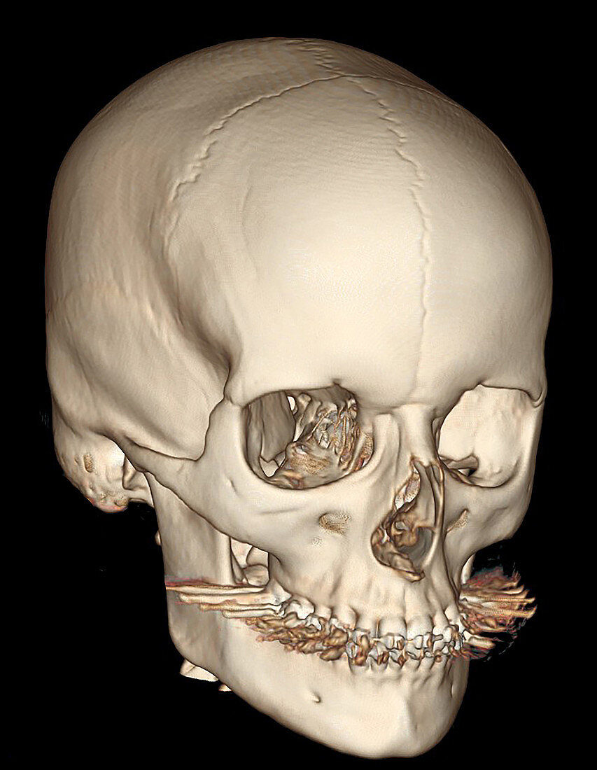 3D CT of Persistent Metopic Suture