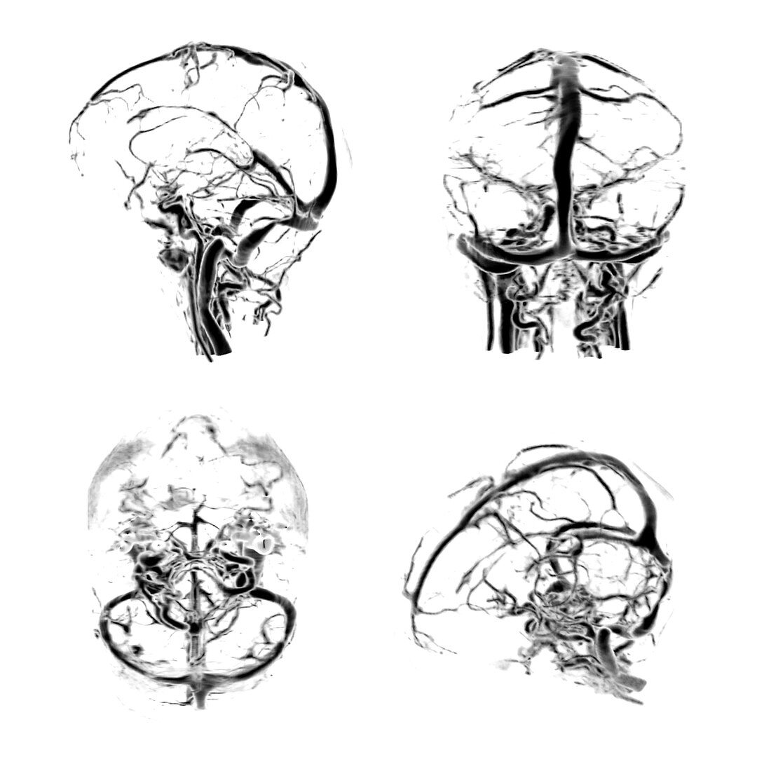 Normal Intracranial Venous System, 3D CT