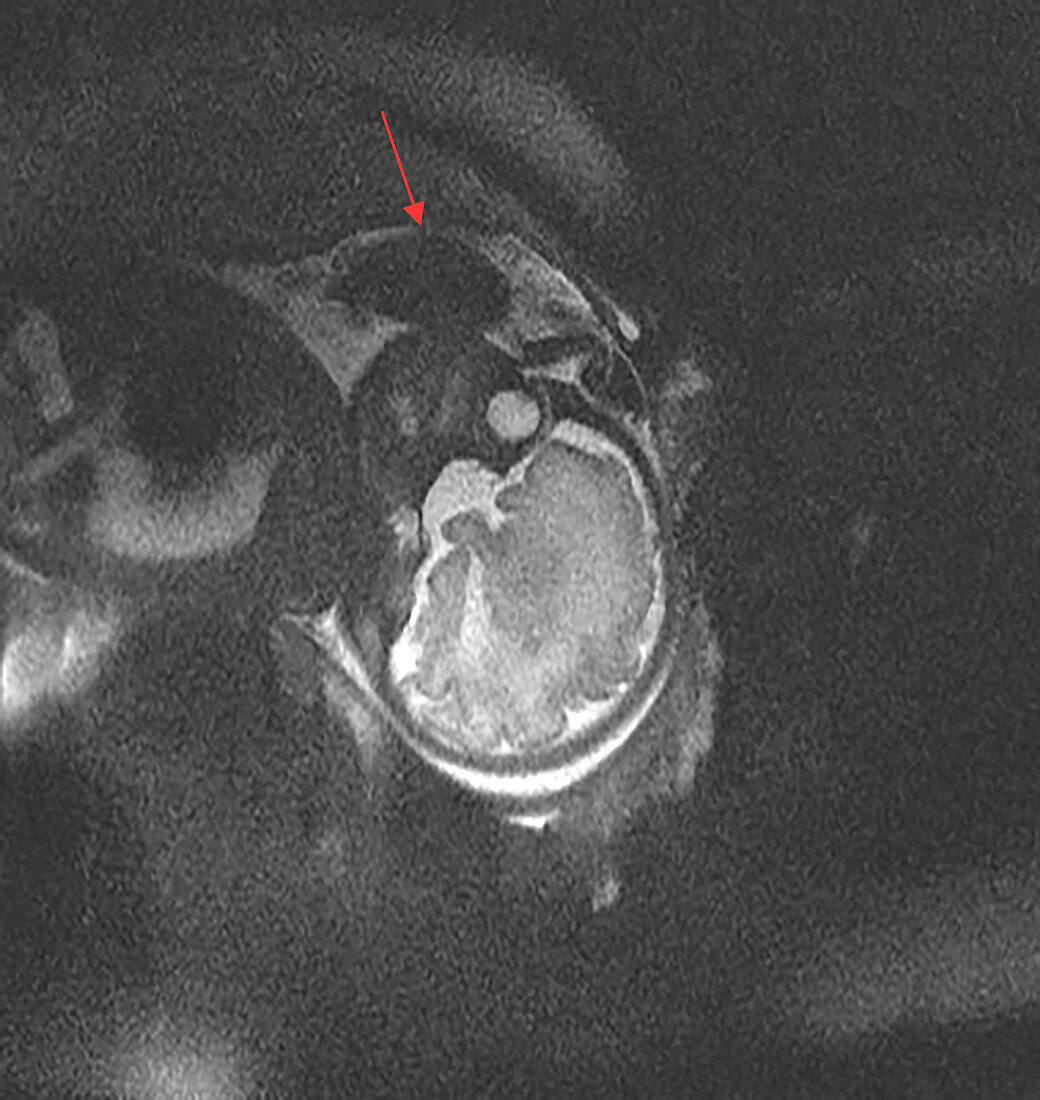 Normal Foetal Brain, MRI