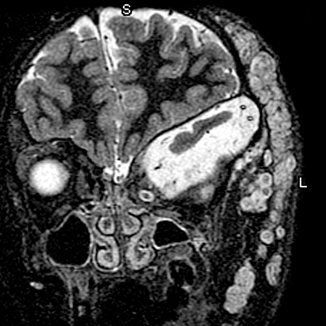 Neurofibromatosis type I, MRI