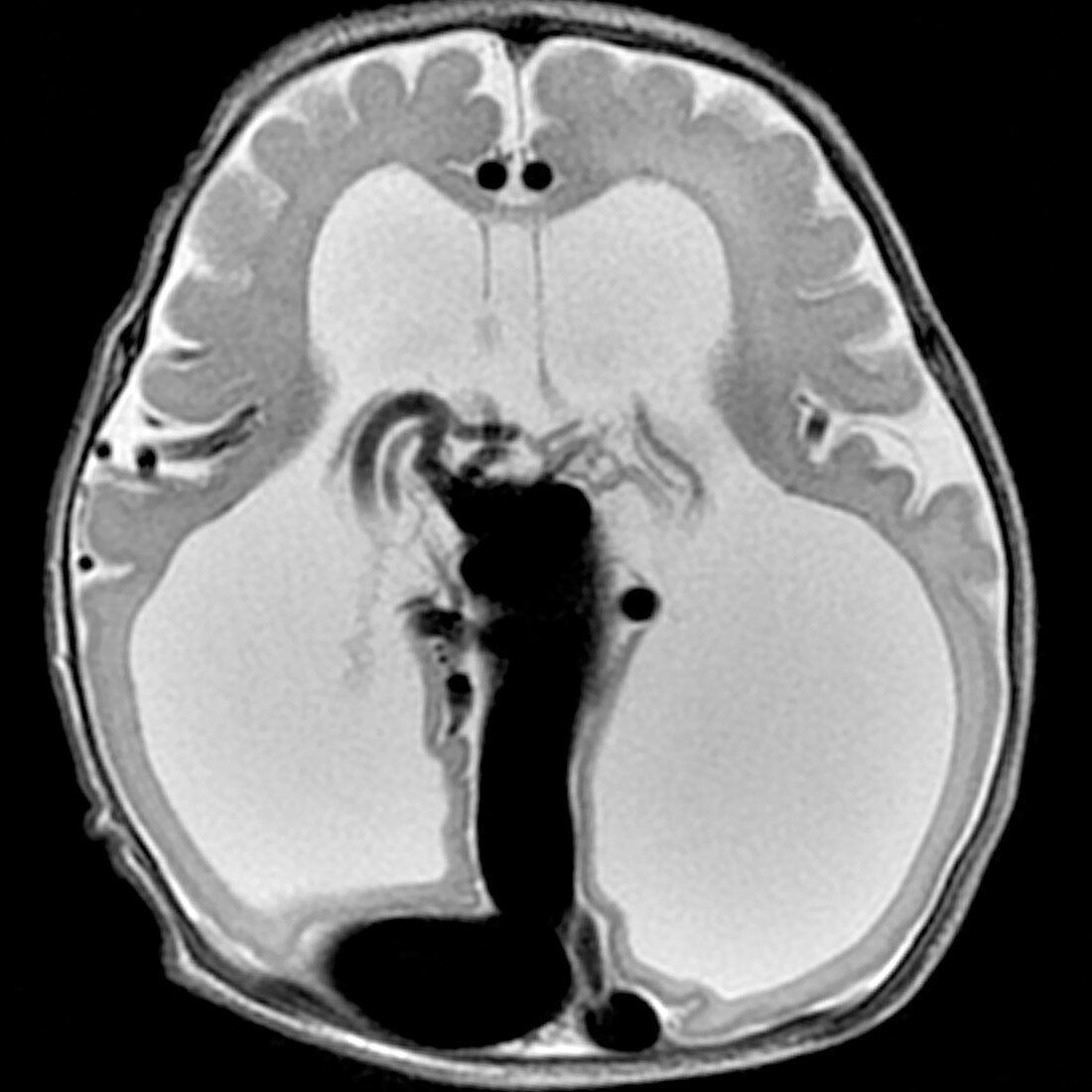 Vein of Galen Malformation, MRI