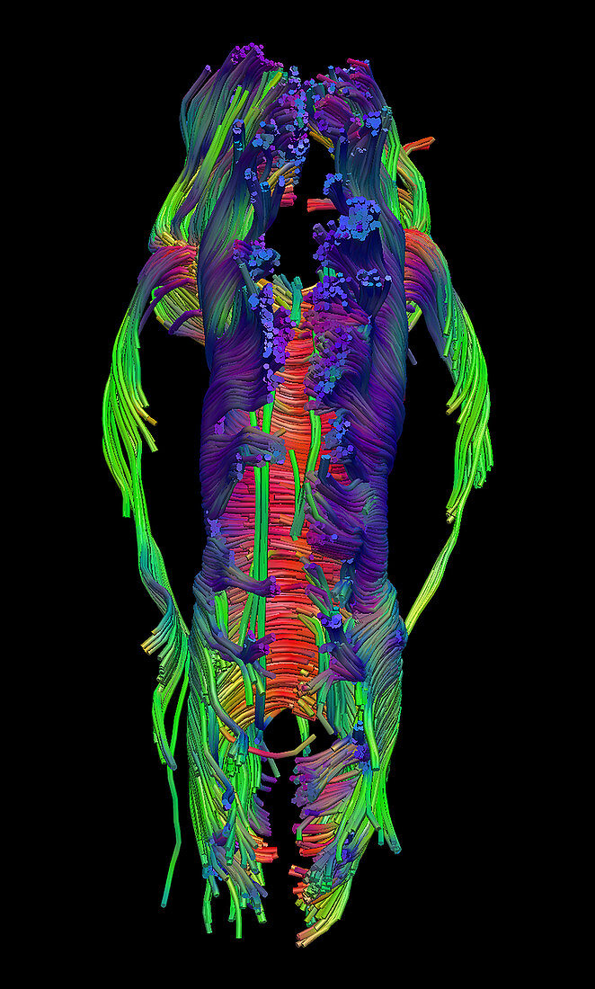 Corpus Callosum, Diffuse Tensor Imaging