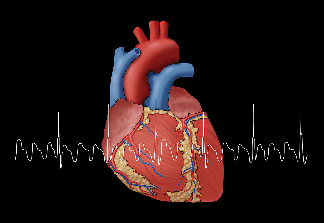 Atrial Flutter with EKG, Illustration
