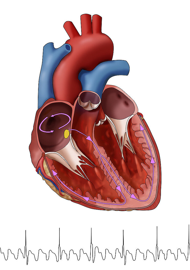 Atrial Flutter with EKG, Illustration