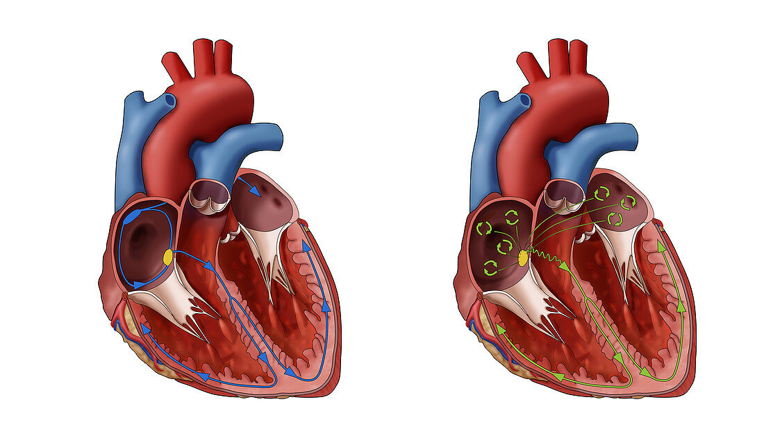 Heart and Atrial Fibrillation, Illustration